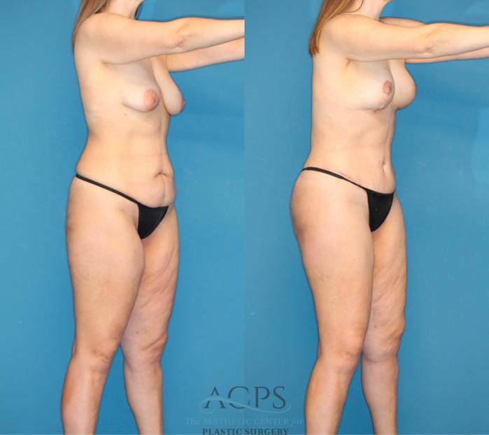 Before & After Mommy Makeover Case 1549 Right Oblique View in Houston, TX