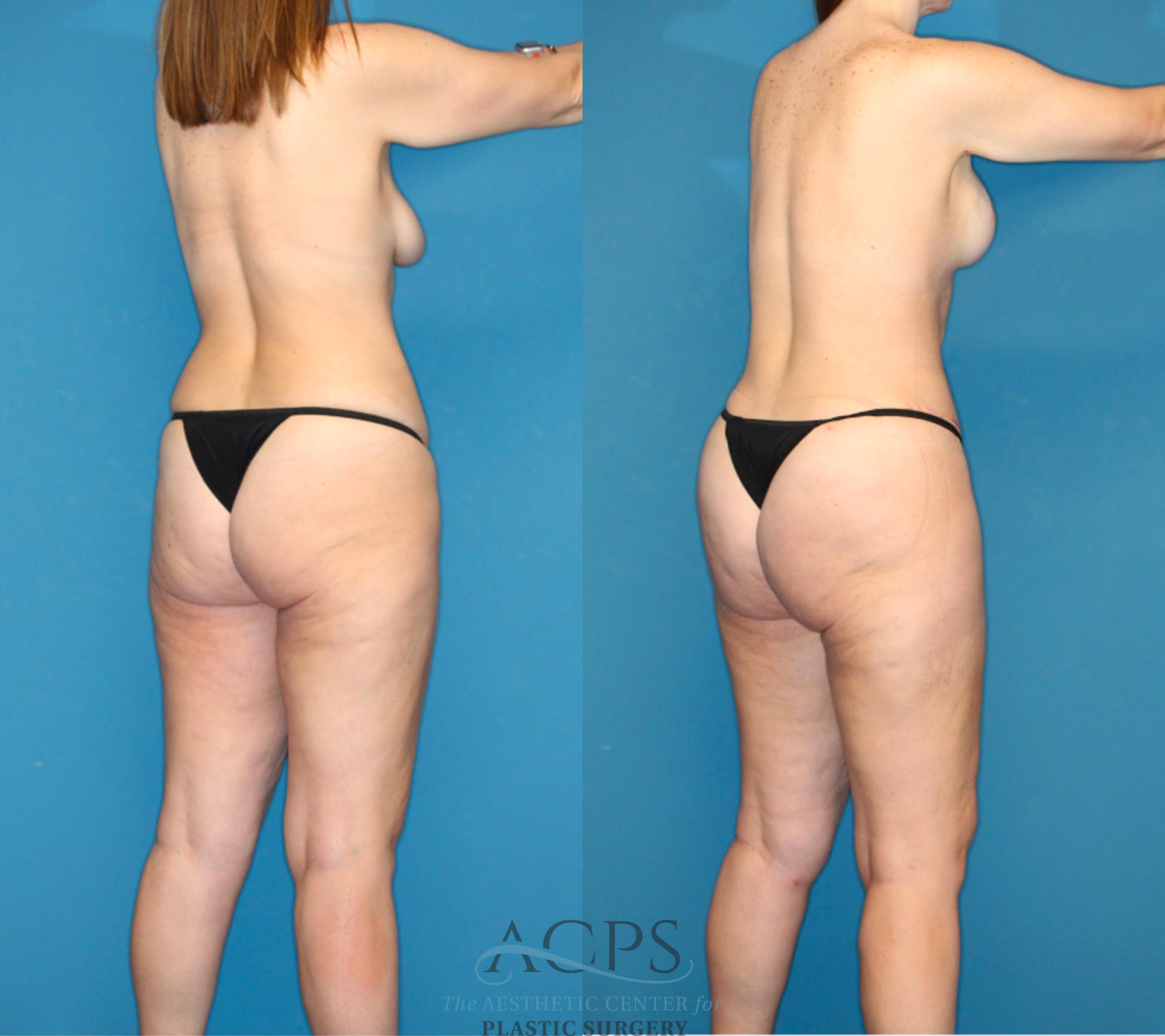 Before & After Mommy Makeover Case 1549 Right Rear View in Houston, TX