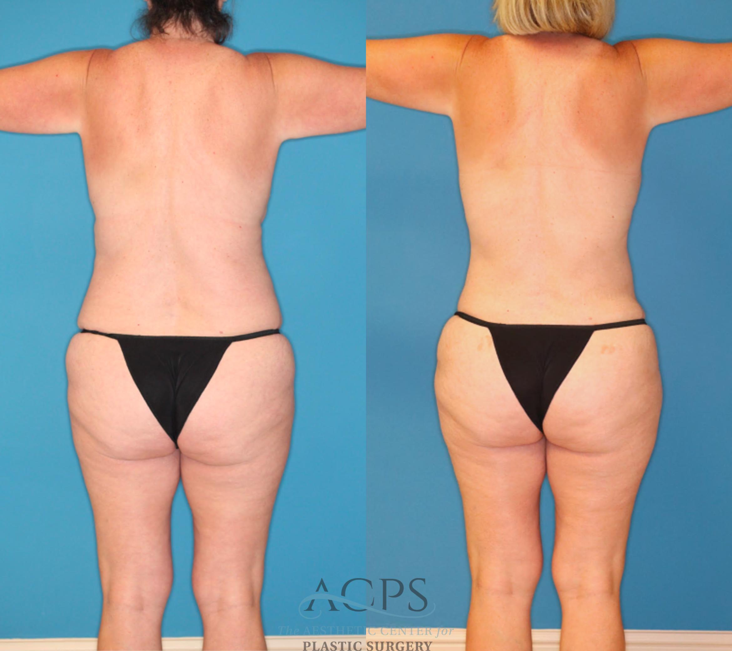 Before & After Mommy Makeover Case 1550 Back View in Houston, TX