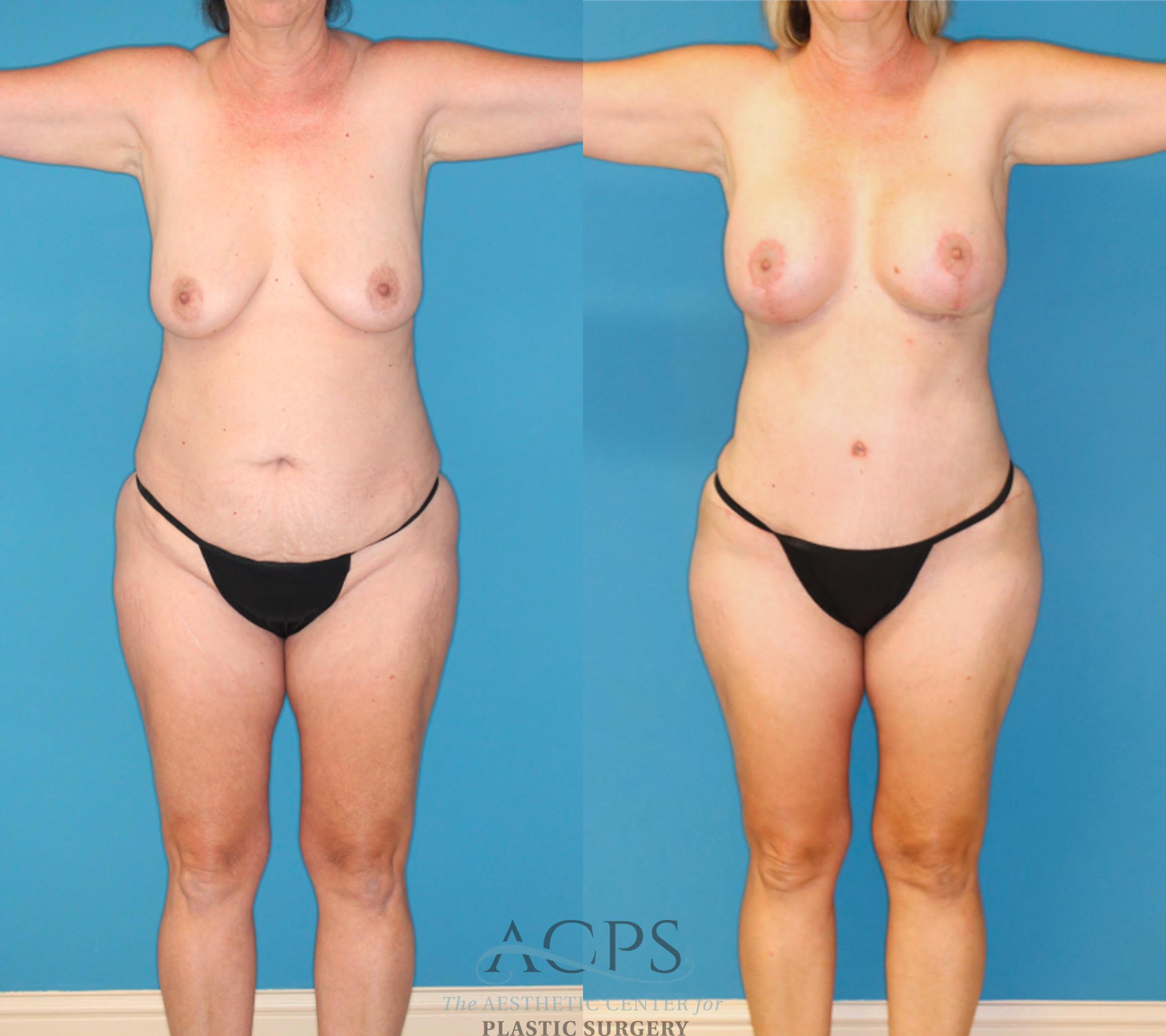 Before & After Mommy Makeover Case 1550 Front View in Houston, TX