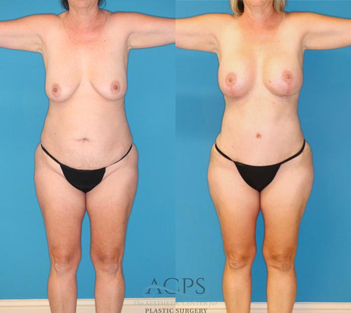 Before & After Mommy Makeover Case 1550 Front View in Houston, TX