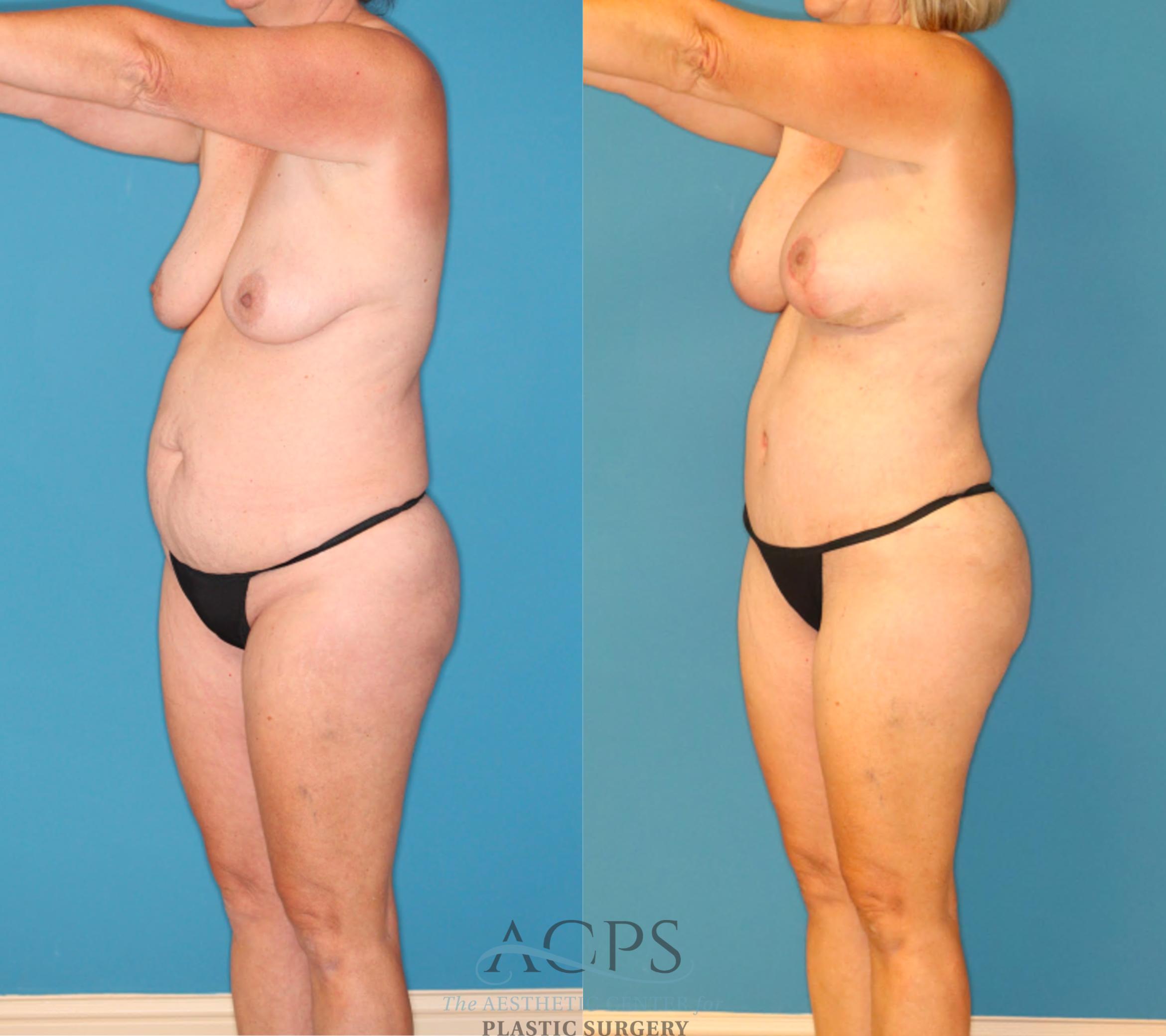 Before & After Mommy Makeover Case 1550 Left Oblique View in Houston, TX