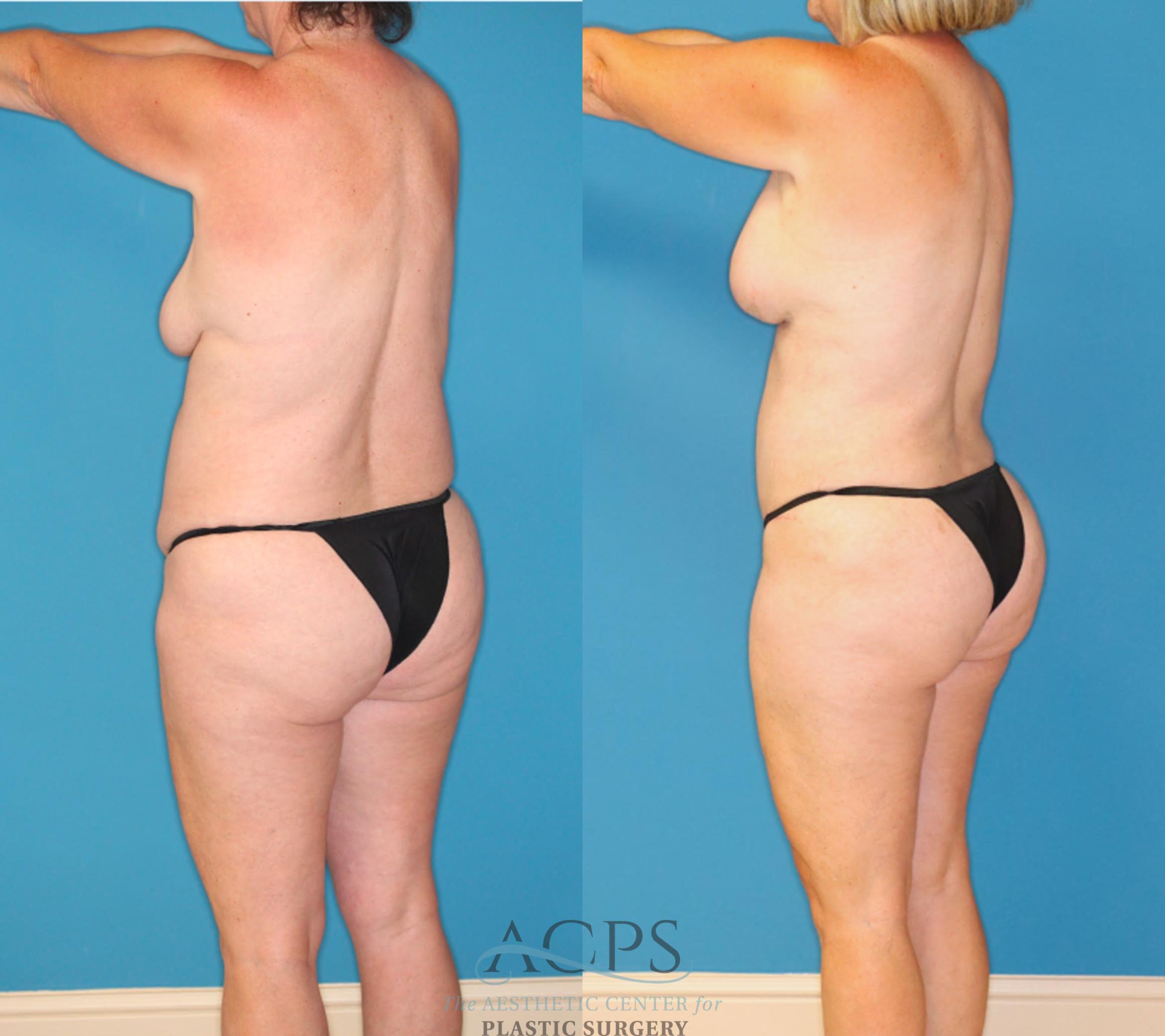 Before & After Mommy Makeover Case 1550 Left Rear View in Houston, TX