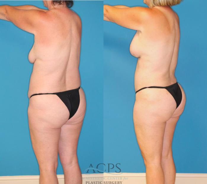 Before & After Mommy Makeover Case 1550 Left Rear View in Houston, TX