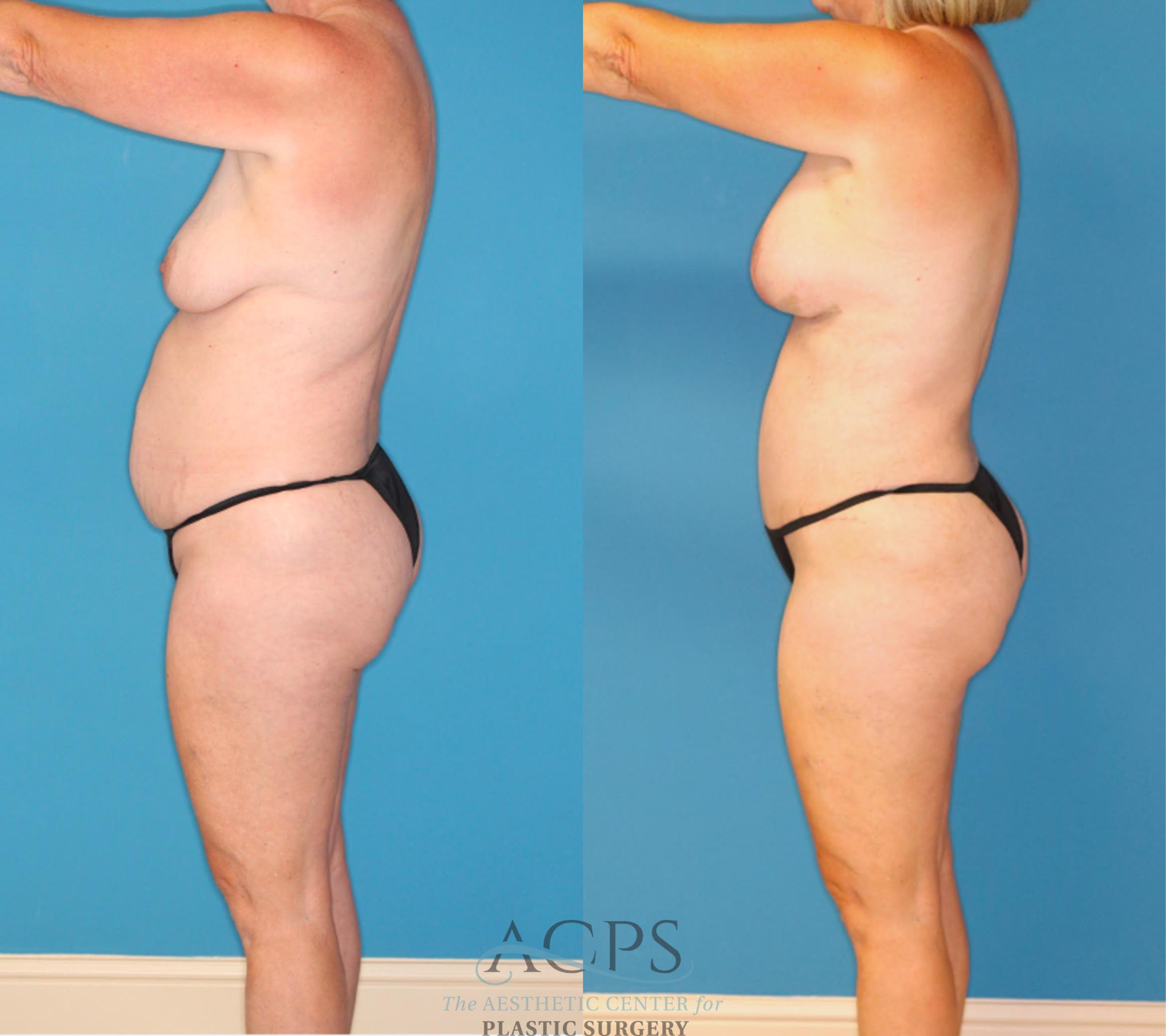 Before & After Mommy Makeover Case 1550 Left Side View in Houston, TX