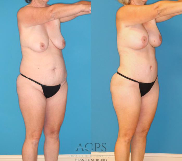 Before & After Mommy Makeover Case 1550 Right Oblique View in Houston, TX