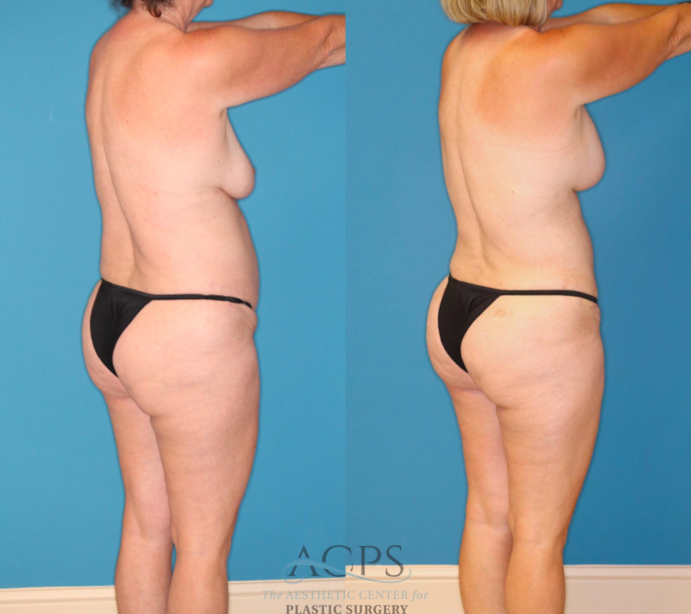 Before & After Mommy Makeover Case 1550 Right Rear View in Houston, TX