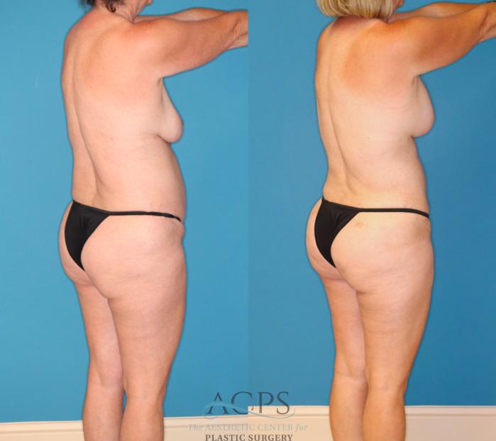 Before & After Mommy Makeover Case 1550 Right Rear View in Houston, TX