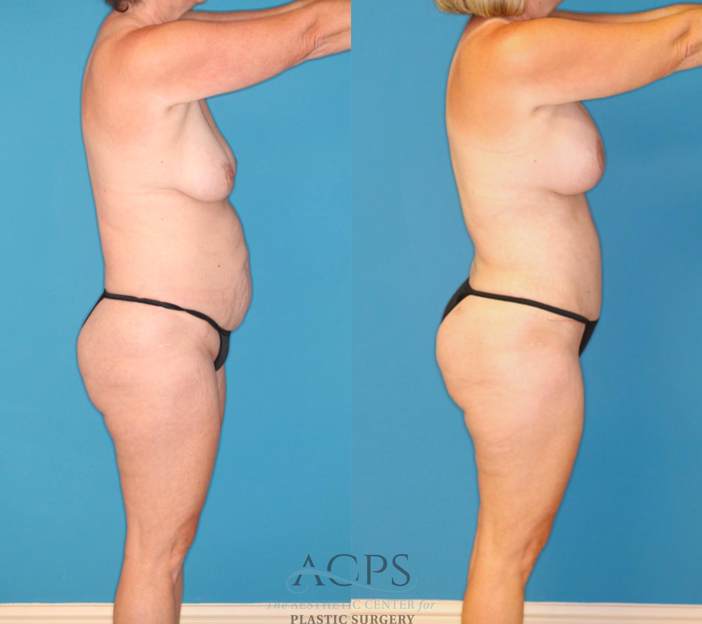 Before & After Mommy Makeover Case 1550 Right Side View in Houston, TX