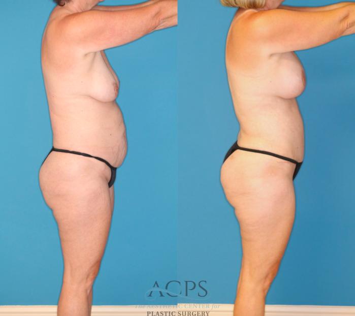 Before & After Mommy Makeover Case 1550 Right Side View in Houston, TX