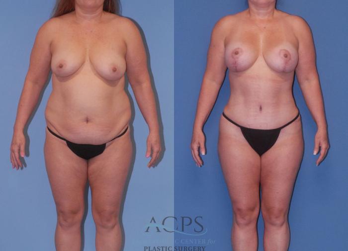 Before & After Mommy Makeover Case 504 Front View: View in Houston, TX