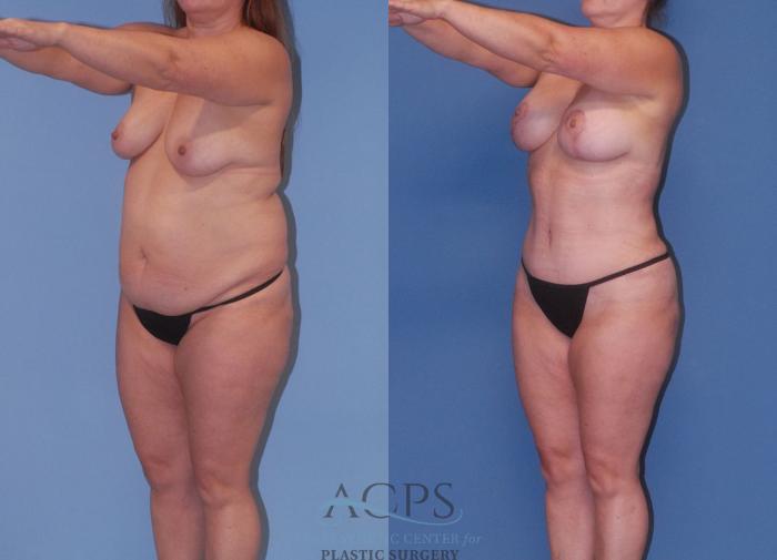 Before & After Mommy Makeover Case 504 Left Oblique View: View in Houston, TX