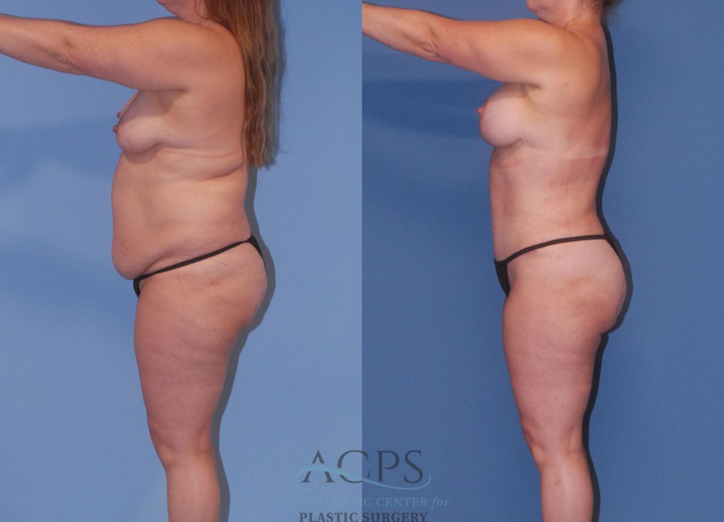 Before & After Mommy Makeover Case 504 Left Side View: View in Houston, TX