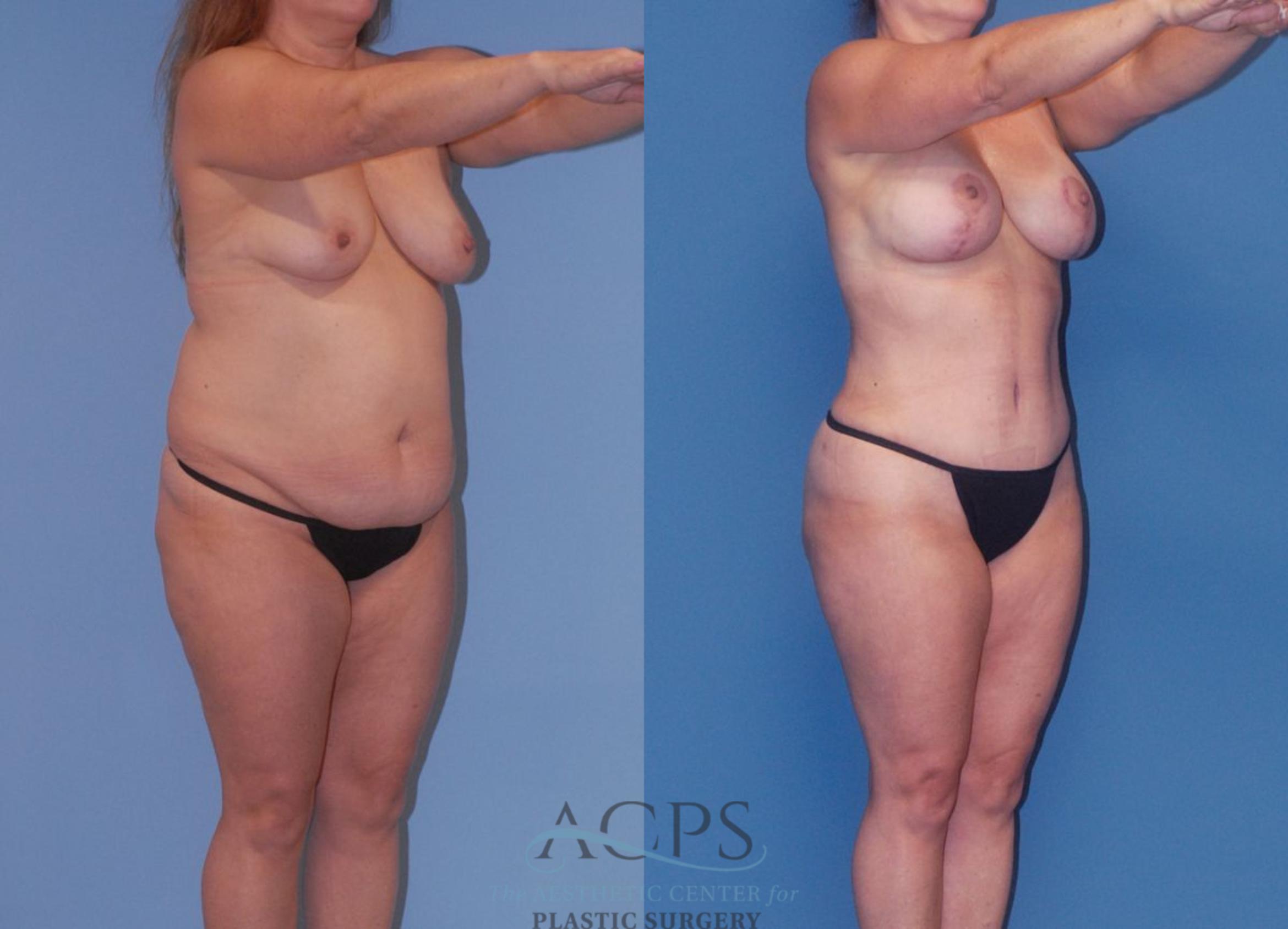 Before & After Mommy Makeover Case 504 Oblique View: View in Houston, TX