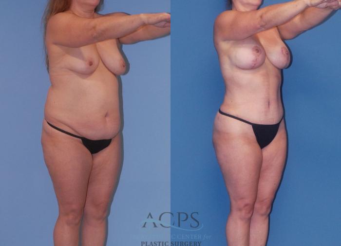 Before & After Mommy Makeover Case 504 Oblique View: View in Houston, TX