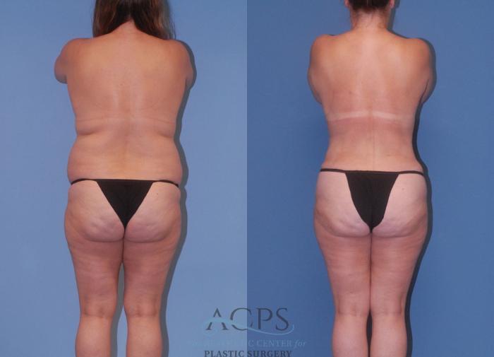 Before & After Mommy Makeover Case 504 Rear View: View in Houston, TX