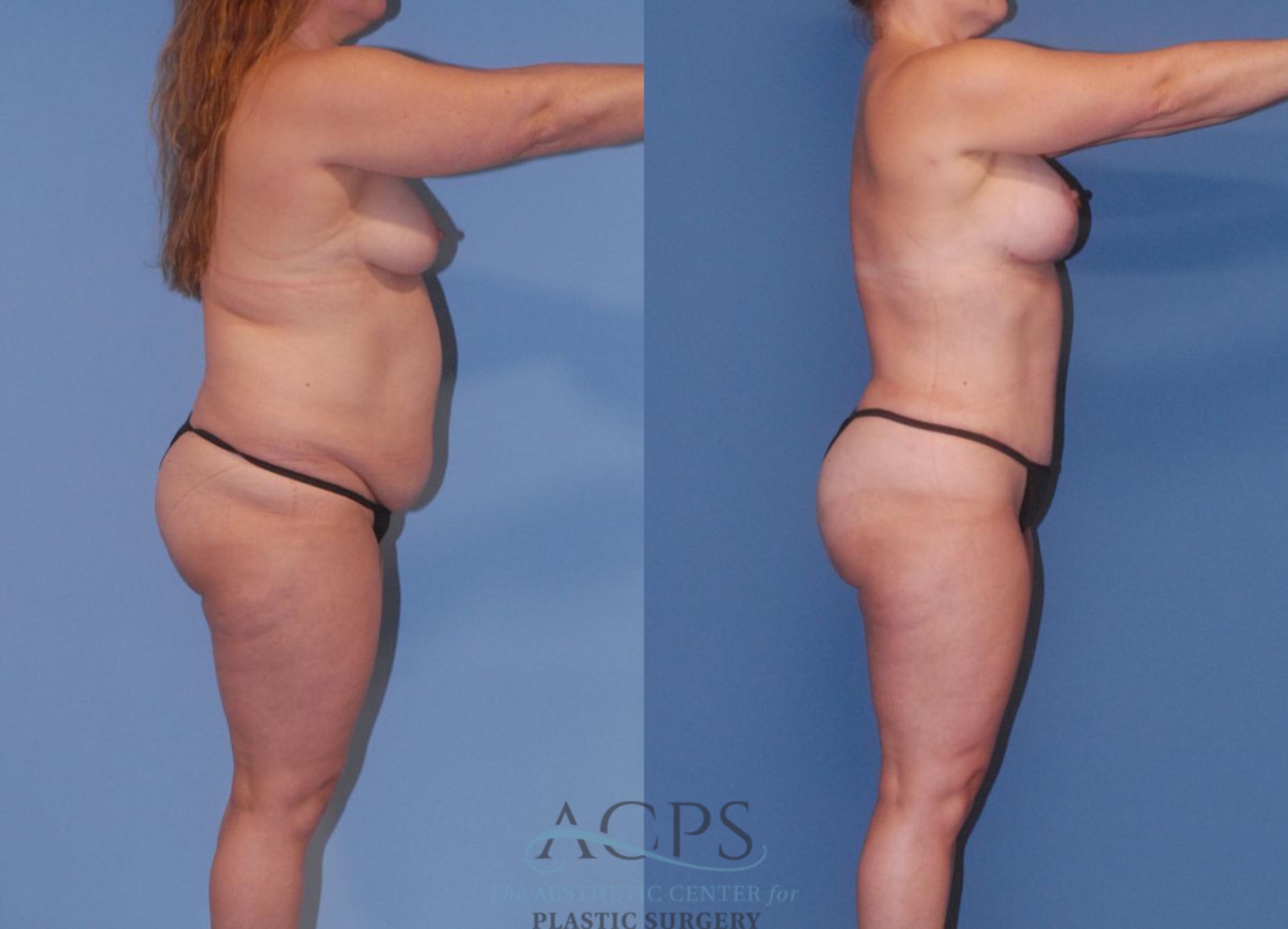 Before & After Mommy Makeover Case 504 Right Side View: View in Houston, TX