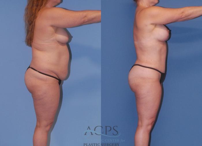 Before & After Mommy Makeover Case 504 Right Side View: View in Houston, TX