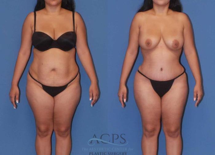 Before & After Mommy Makeover Case 505 Front View: View in Houston, TX