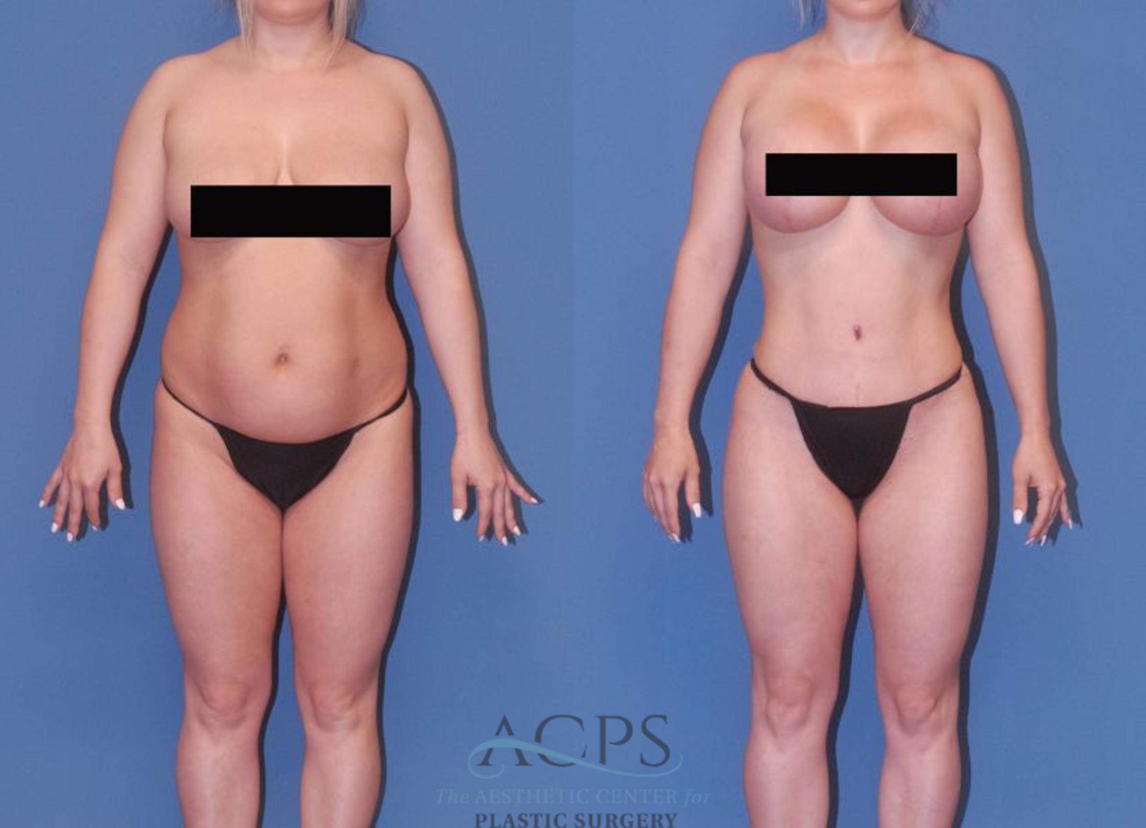 Before & After Mommy Makeover Case 506 Front View: View in Houston, TX
