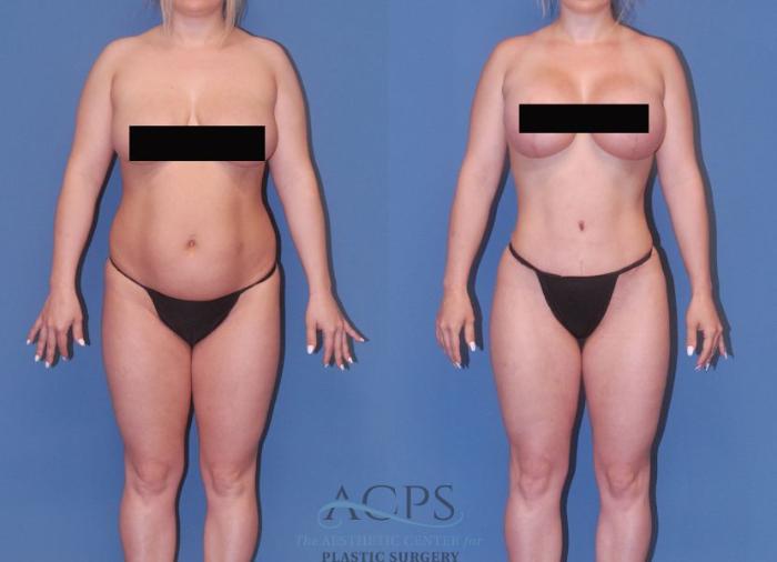Before & After Mommy Makeover Case 506 Front View: View in Houston, TX