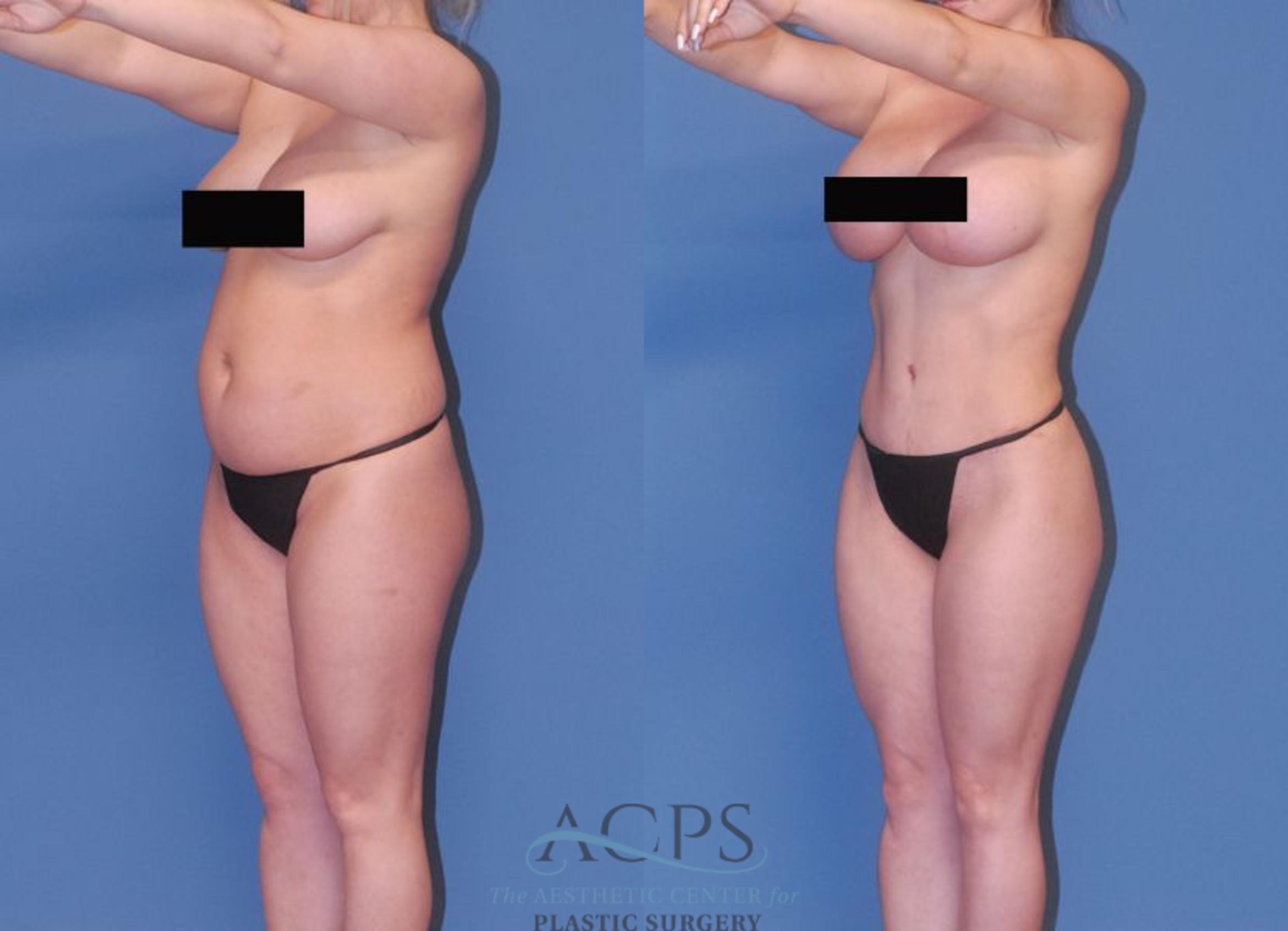 Before & After Mommy Makeover Case 506 Left Oblique View: View in Houston, TX