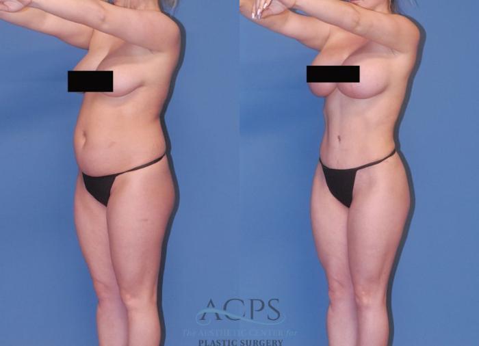 Before & After Mommy Makeover Case 506 Left Oblique View: View in Houston, TX