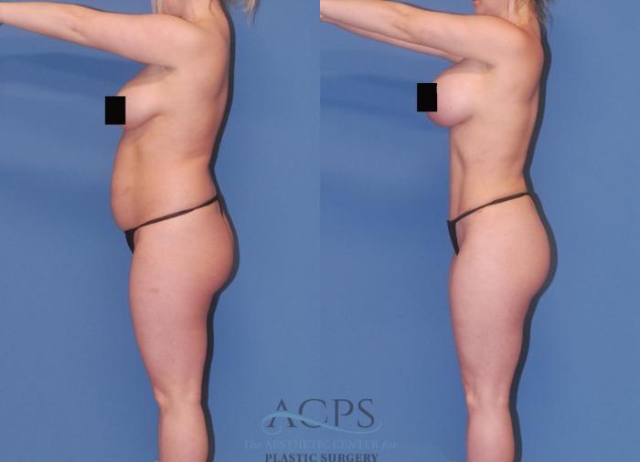 Before & After Mommy Makeover Case 506 Left Side View: View in Houston, TX