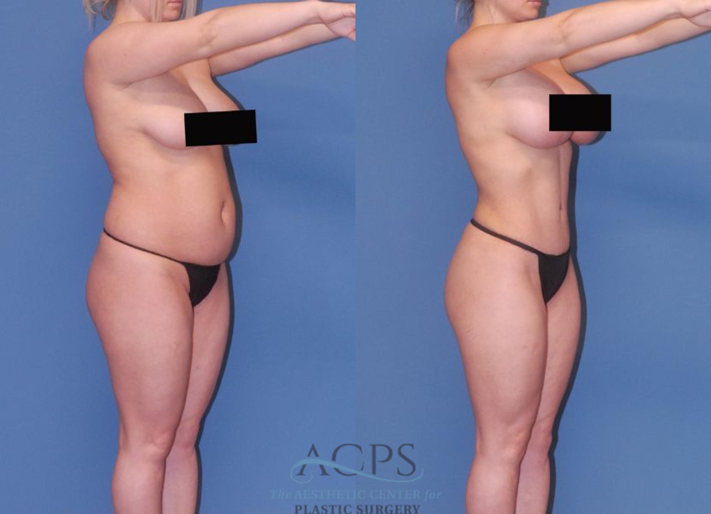 Before & After Mommy Makeover Case 506 Oblique View: View in Houston, TX