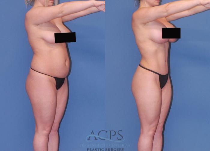 Before & After Mommy Makeover Case 506 Oblique View: View in Houston, TX