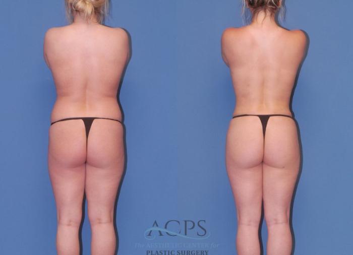Before & After Mommy Makeover Case 506 Rear View: View in Houston, TX
