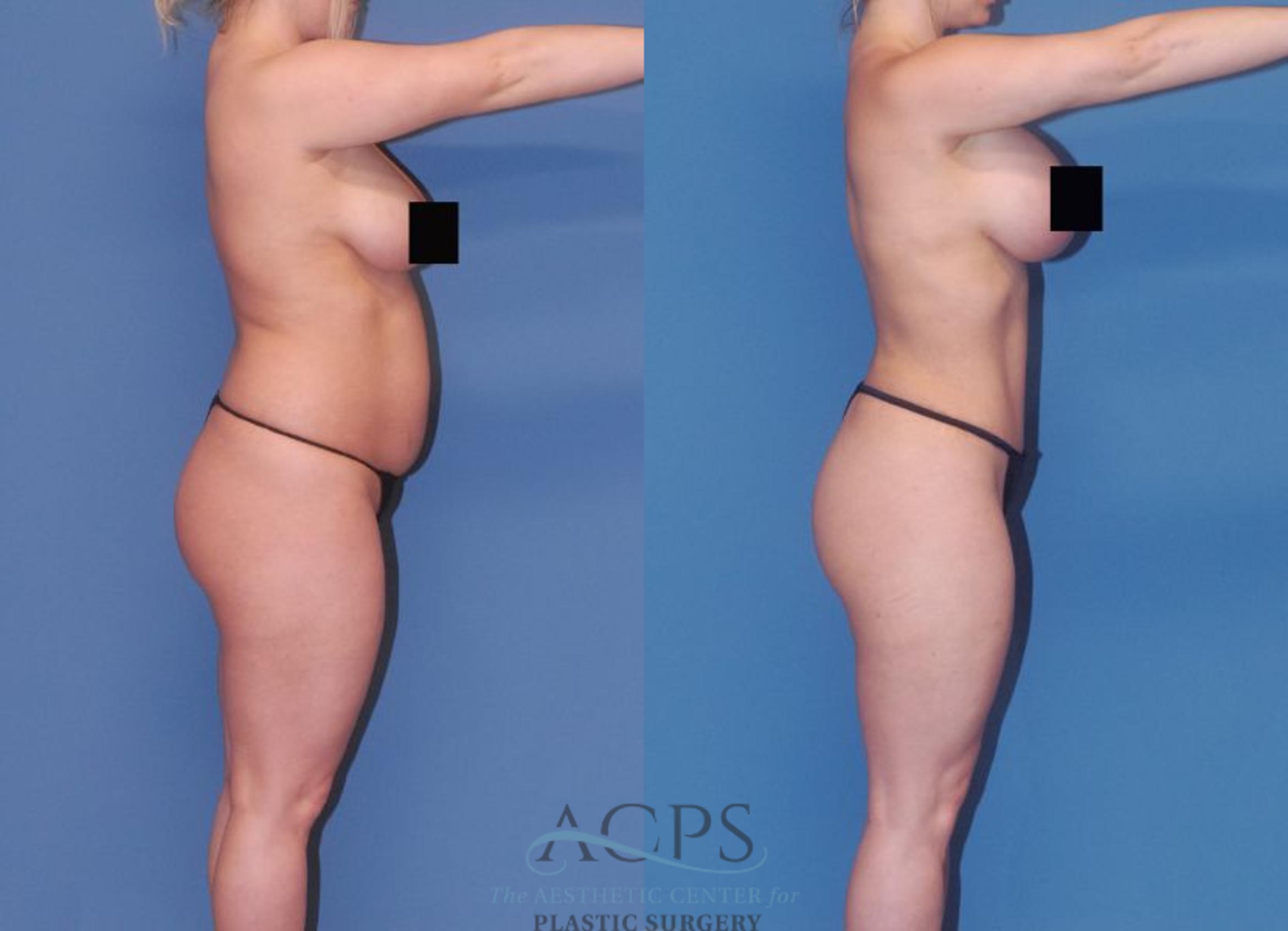 Before & After Mommy Makeover Case 506 Right Side View: View in Houston, TX