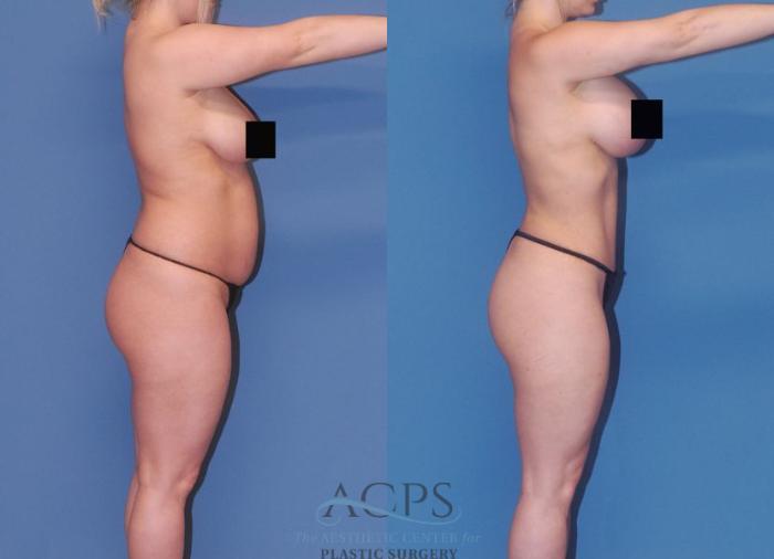 Before & After Mommy Makeover Case 506 Right Side View: View in Houston, TX
