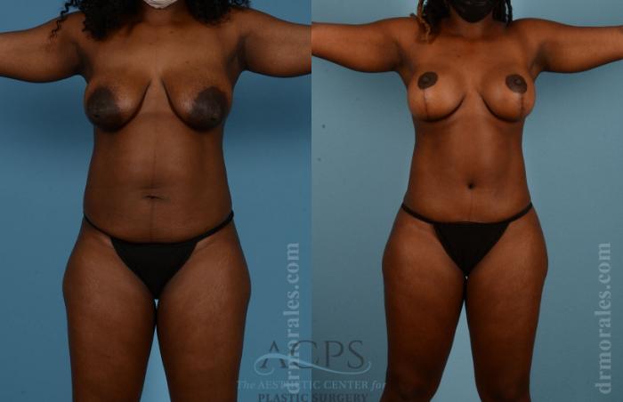 Before & After Mommy Makeover Case 507 Front View: View in Houston, TX