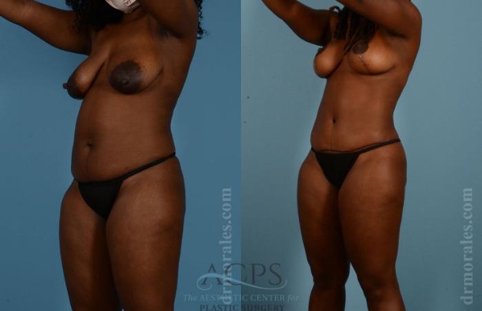 Before & After Mommy Makeover Case 507 Oblique View: View in Houston, TX