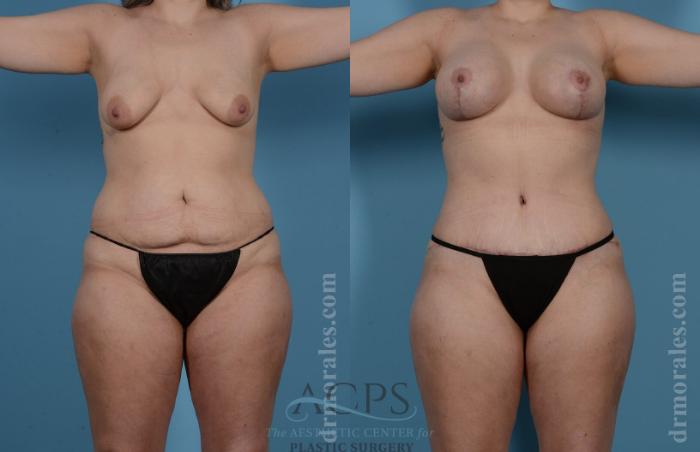 Before & After Mommy Makeover Case 508 Front View: View in Houston, TX