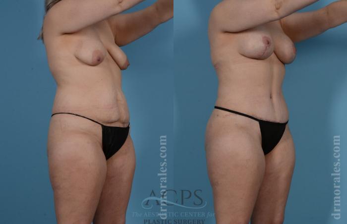 Before & After Mommy Makeover Case 508 Oblique View: View in Houston, TX