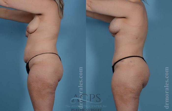 Before & After Mommy Makeover Case 508 Side View: View in Houston, TX