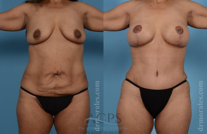 Before & After Mommy Makeover Case 509 Front View: View in Houston, TX