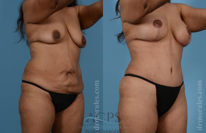 Before & After Mommy Makeover Case 509 Oblique View: View in Houston, TX