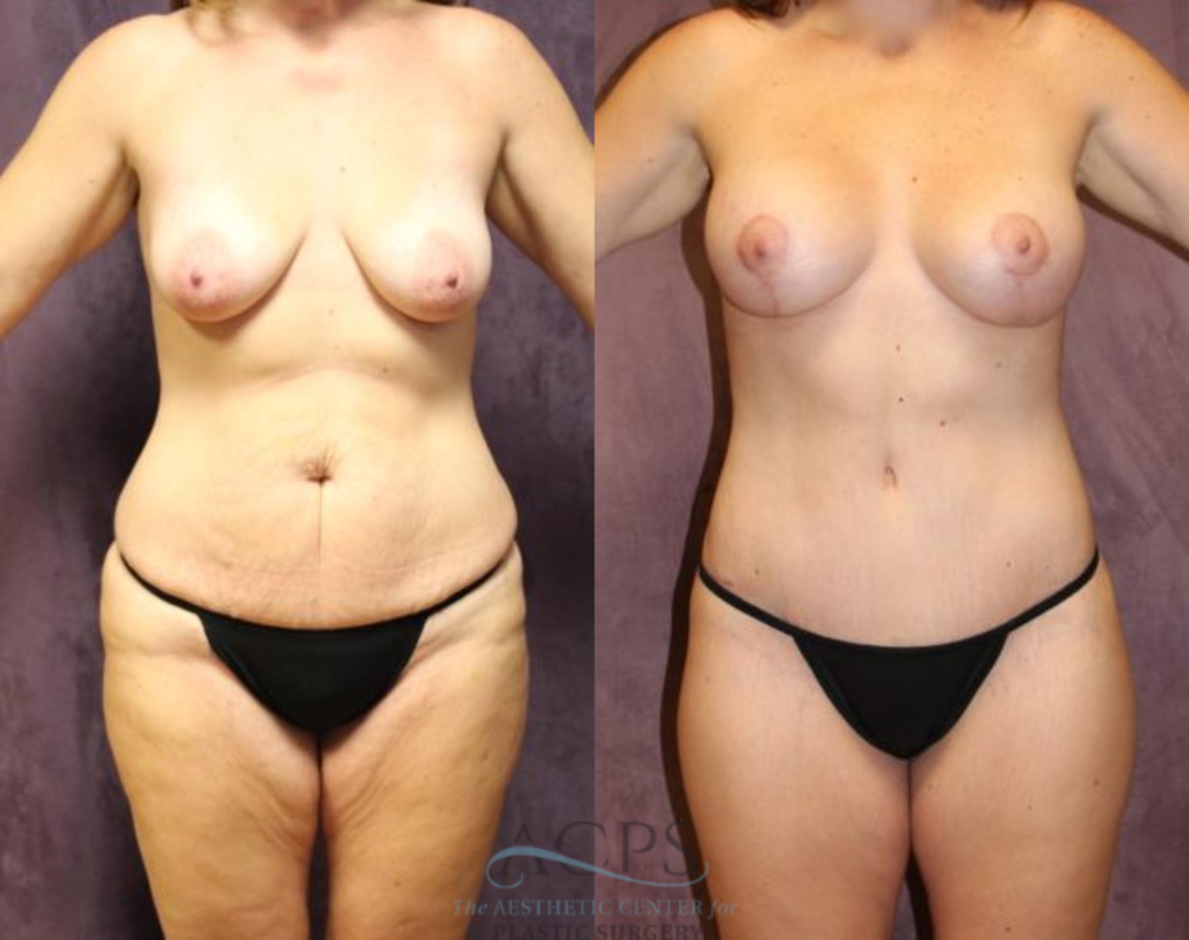 Before & After Mommy Makeover Case 510 Front View: View in Houston, TX