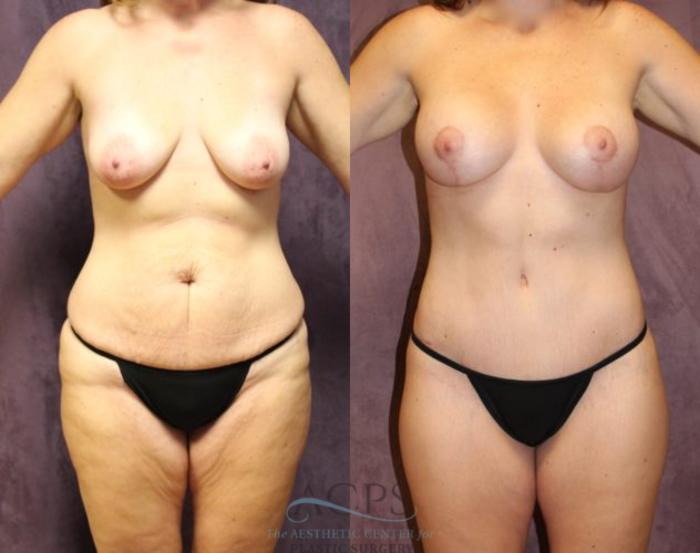 Before & After Mommy Makeover Case 510 Front View: View in Houston, TX