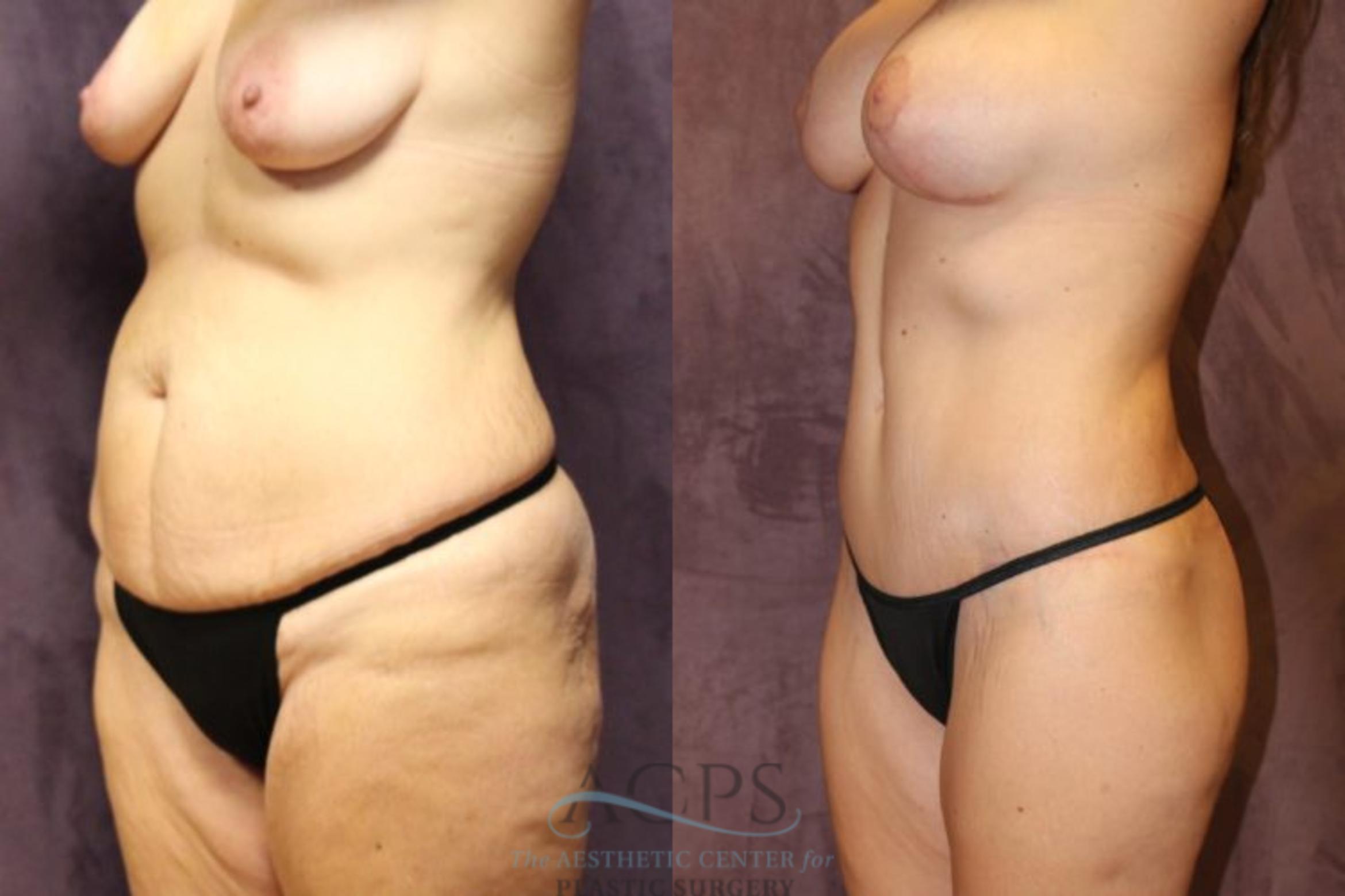 Before & After Mommy Makeover Case 510 Oblique View: View in Houston, TX