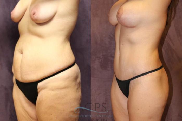 Before & After Mommy Makeover Case 510 Oblique View: View in Houston, TX