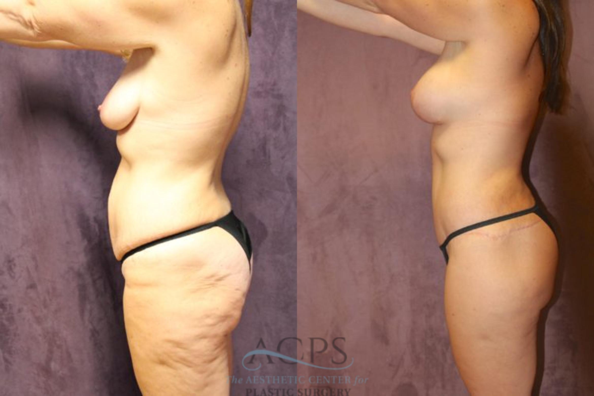 Before & After Mommy Makeover Case 510 Side View: View in Houston, TX