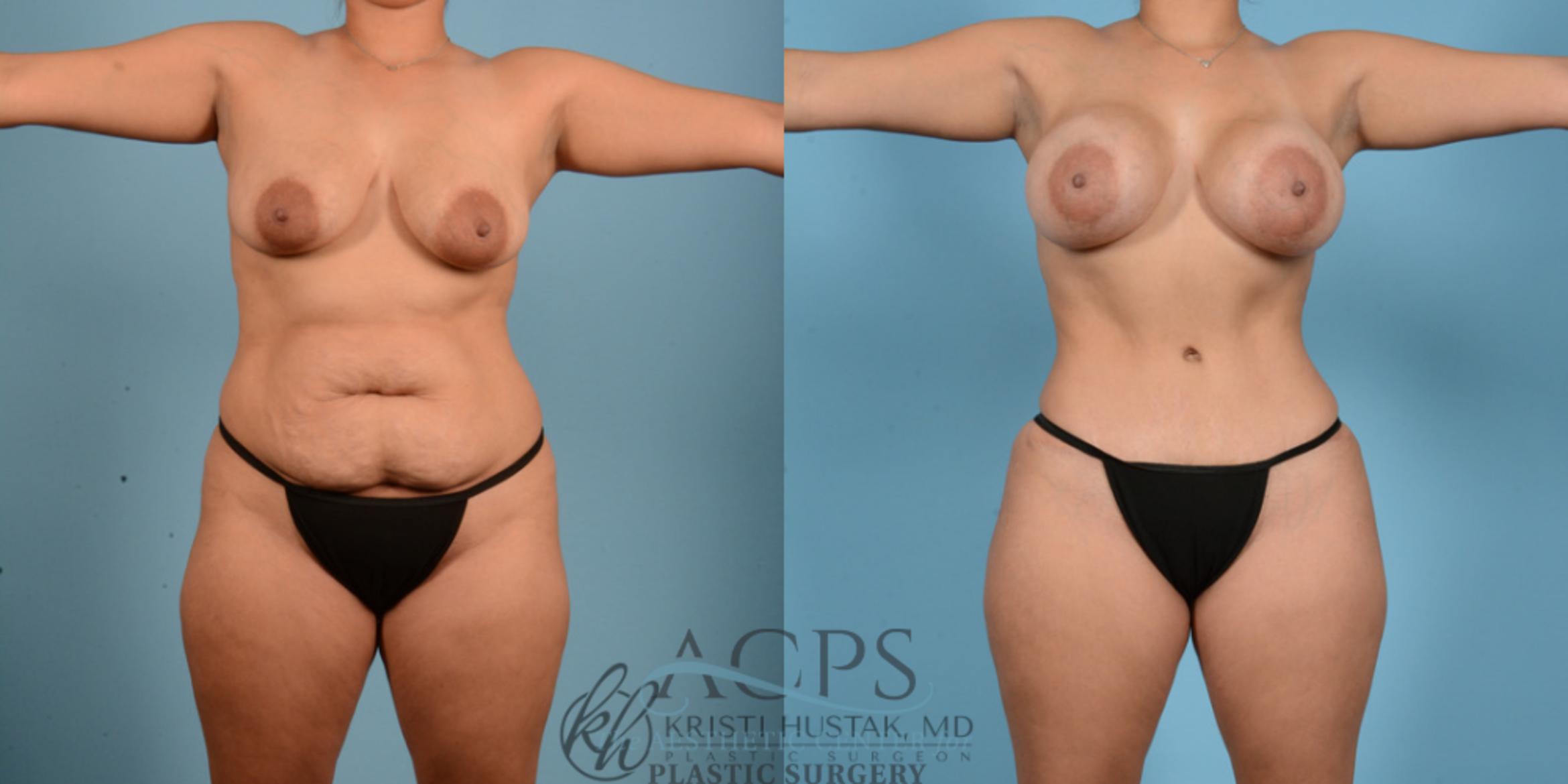 Before & After Mommy Makeover Case 511 Front View: View in Houston, TX