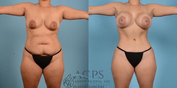 Before & After Mommy Makeover Case 511 Front View: View in Houston, TX