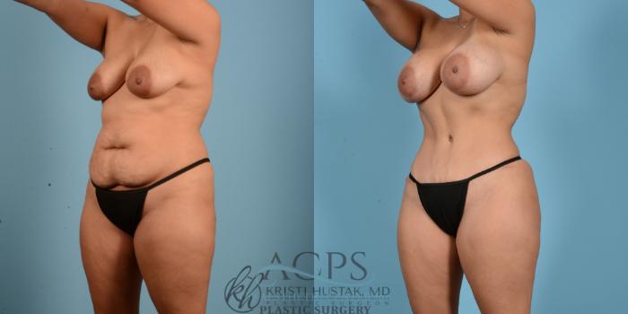 Before & After Mommy Makeover Case 511 Left Oblique View: View in Houston, TX