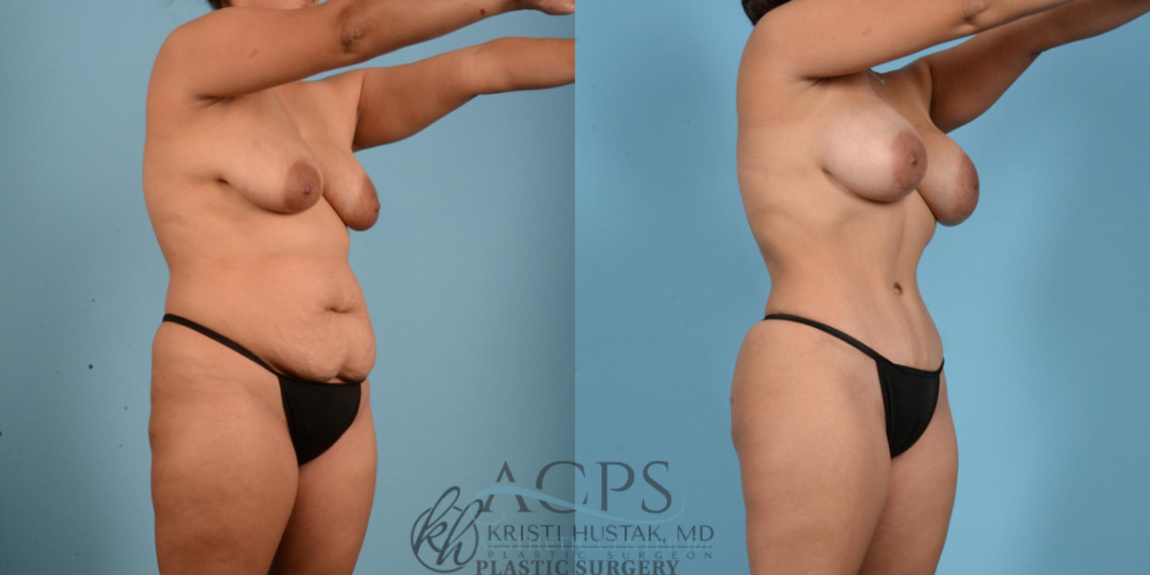 Before & After Mommy Makeover Case 511 Oblique View: View in Houston, TX