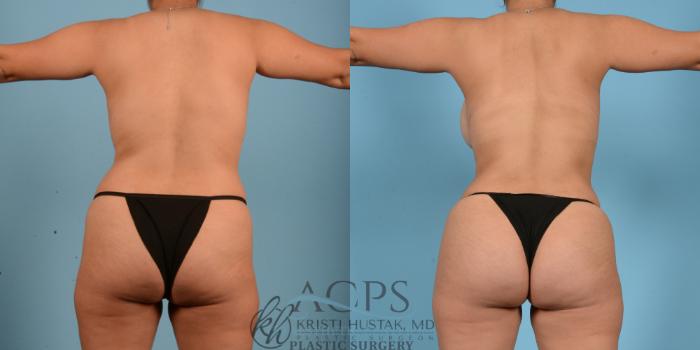 Before & After Mommy Makeover Case 511 Rear View: View in Houston, TX
